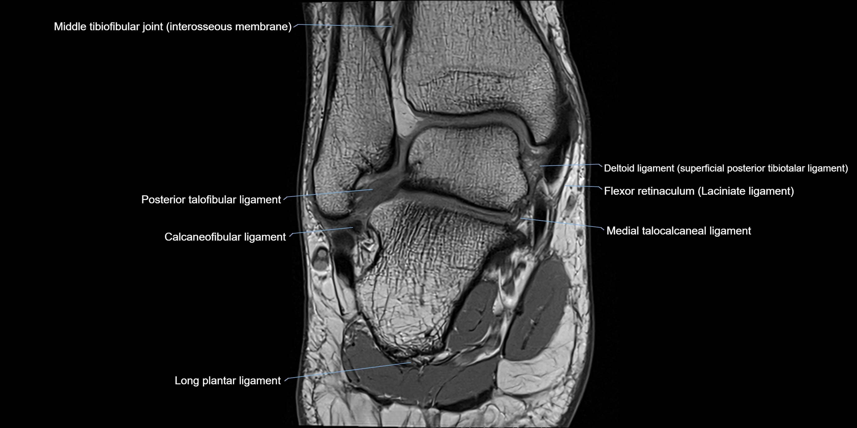 MRI Ankle coronal ligaments cross sectional anatomy 3T  radiology  image-img-00001-00015.webp